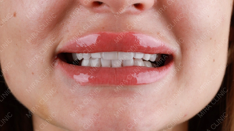 Veneers Final result 